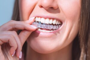 paciente sosteniendo alineador de invisalign