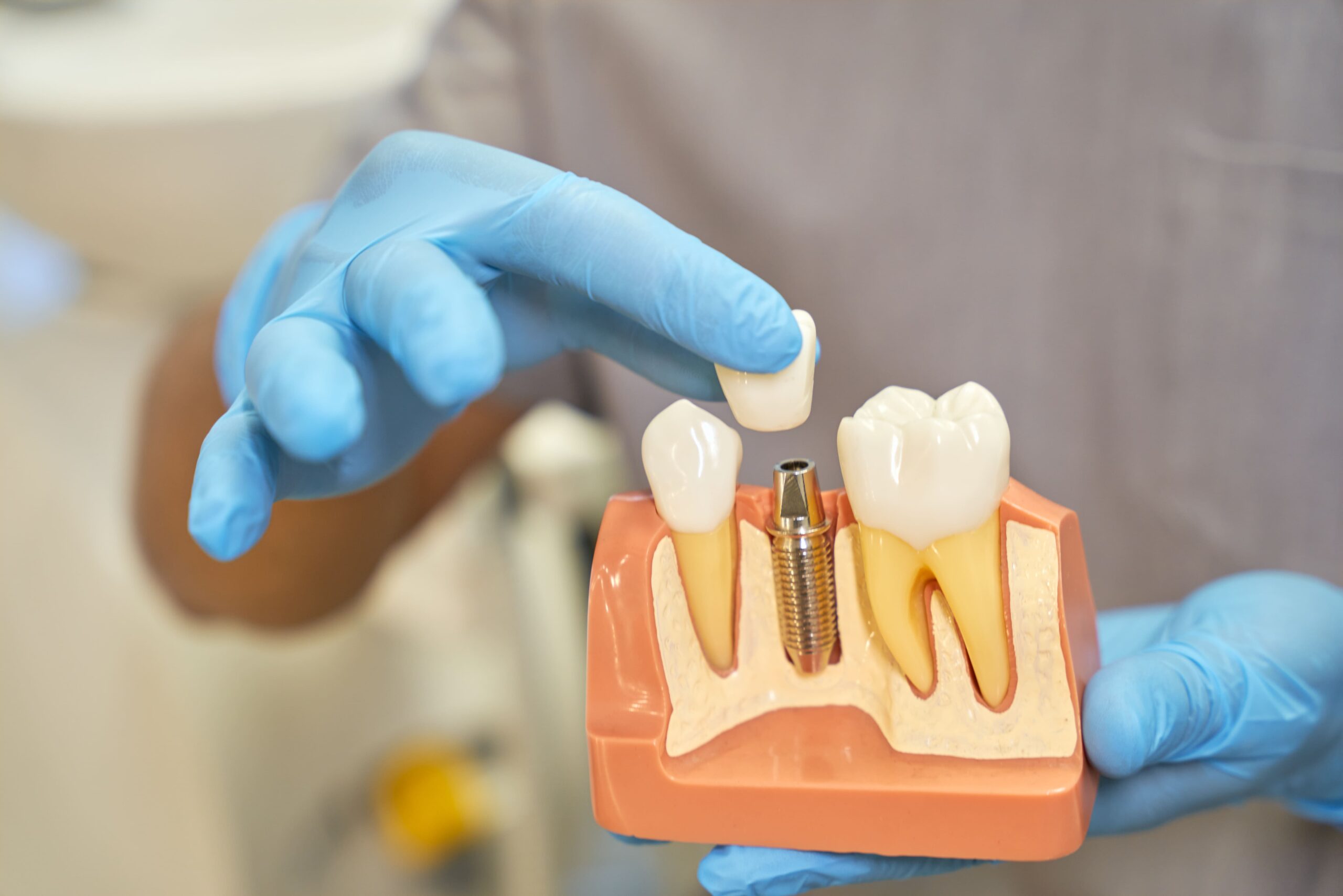Implantes dentales en Coín - clínica dental Vitelier