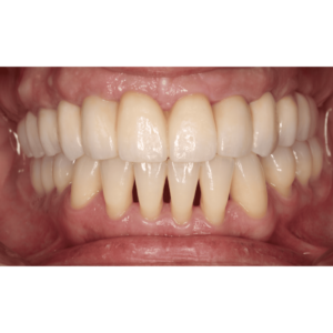 implantes-dentales-caso-de-exito1-Vitelier