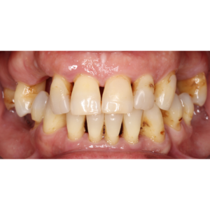 implantes-dentales-caso-de-exito1-antes-vitelier