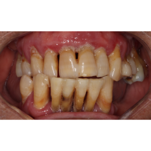 implantes-dentales-caso-de-exito2-antes-vitelier