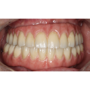 implantes-dentales-caso-de-exito2-despues-vitelier