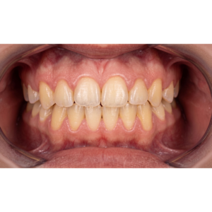 ortodoncia-invisible-invisaling-en-coin-caso-ortodoncia-clinica-dental-vitelier (2)