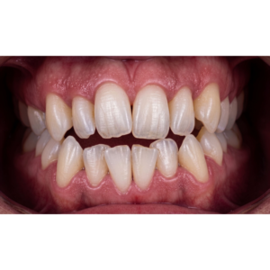 ortodoncia-invisible-invisaling-en-coin-caso-ortodoncia-clinica-dental-vitelier (3)