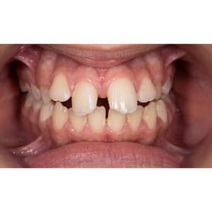 ortodoncia-invisible-invisaling-en-coin-caso-ortodoncia-clinica-dental-vitelier