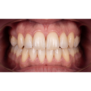 ortodoncia-invisible-invisaling-en-coin-caso-ortodoncia-clinica-dental-vitelier (4)