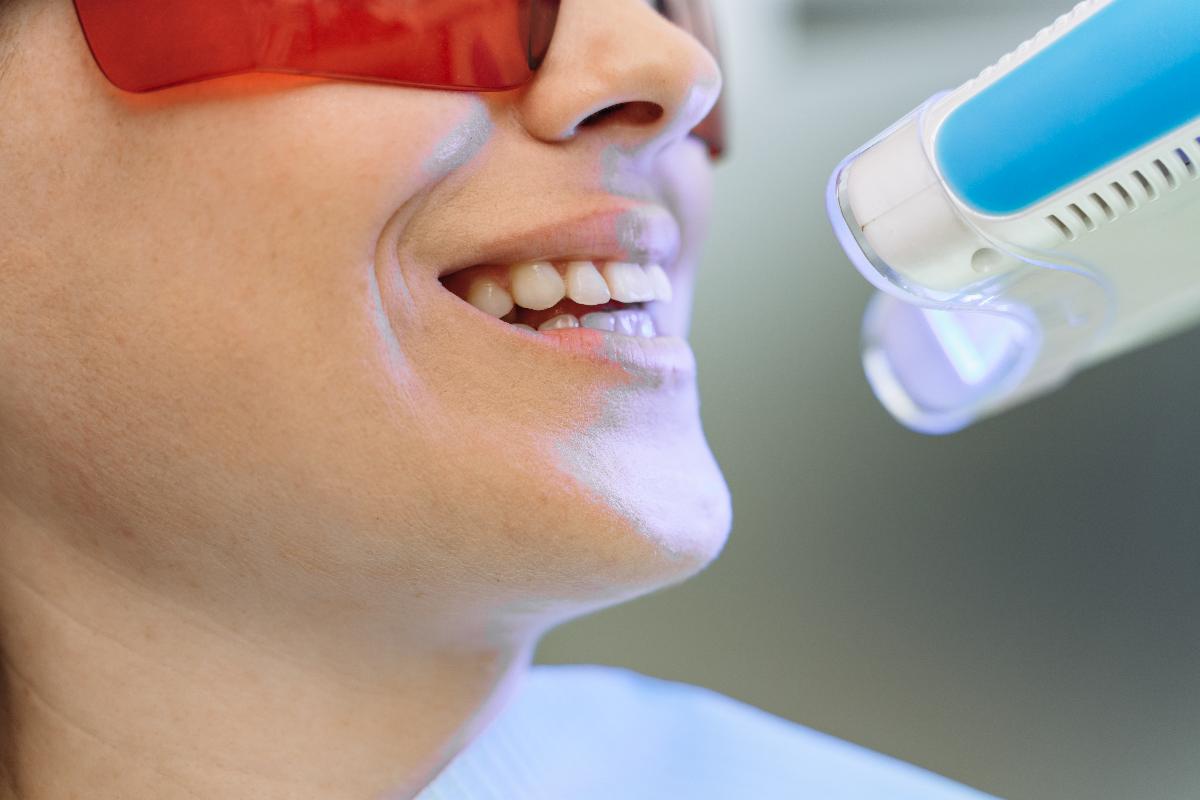 Imagen de Paciente haciendose un blanqueamiento dental en coin en vitelier clinica dental