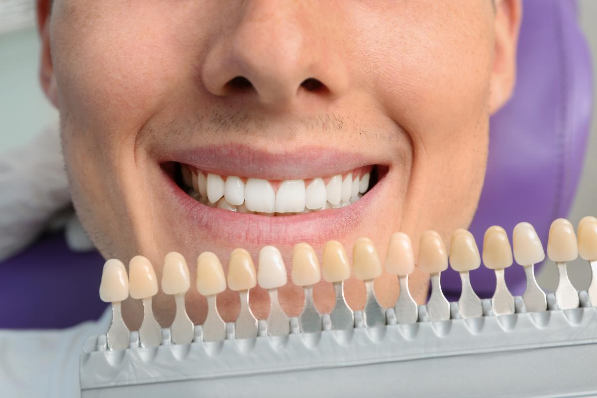 carillas dentales en coin clinica dental vitelier
