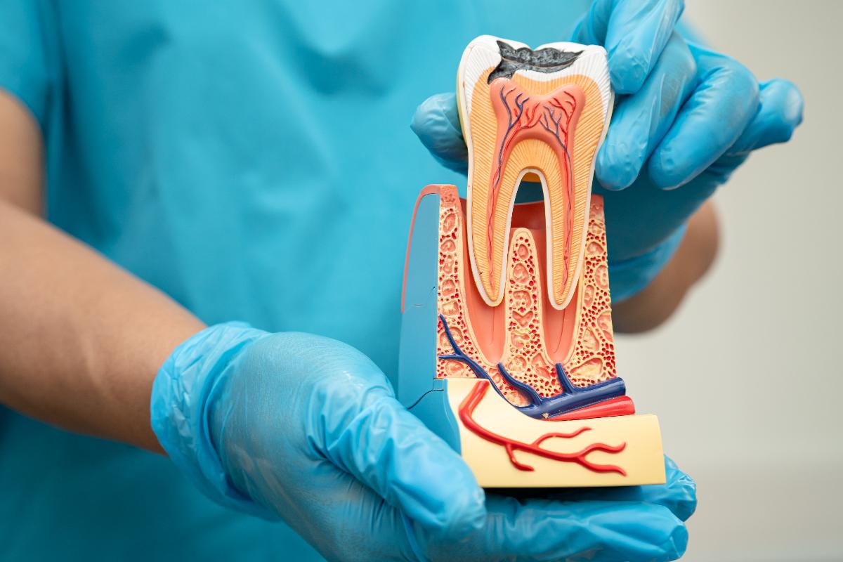Imagen de un molde explicando al paciente en que consiste la endodoncia en coin en la clinica dental vitelier